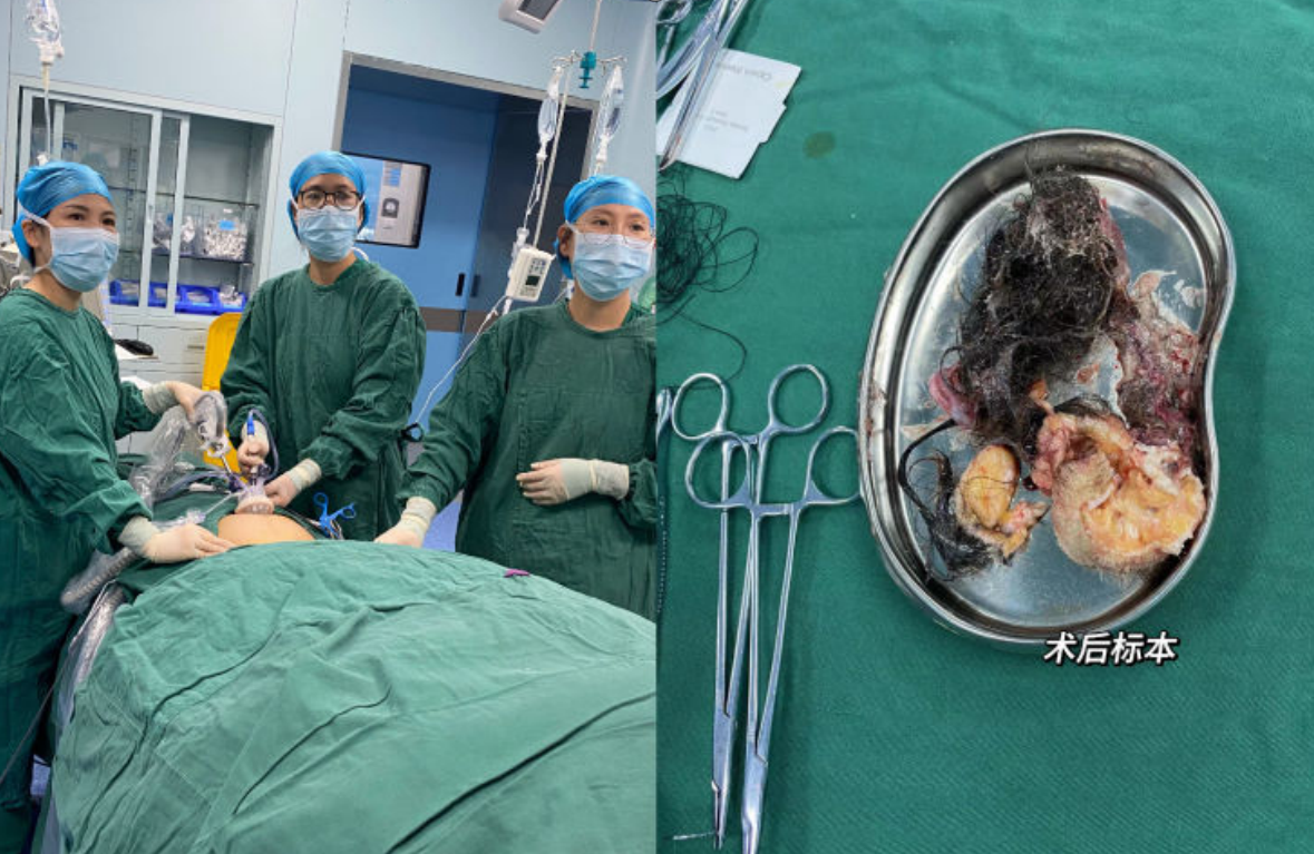 肚脐“打洞”，圆您爱美之心：云梦县人民医院妇产科成功完成一例单孔腹腔镜下卵巢畸胎瘤剥除术